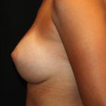 Breast Augmentation - Shaped Silicone Implants Before & After Patient #29070