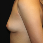 Breast Augmentation - Shaped Silicone Implants Before & After Patient #29070