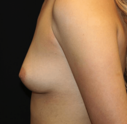 Breast Augmentation - Shaped Silicone Implants Before & After Patient #29070