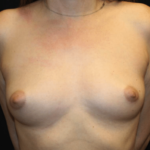 Breast Augmentation - Round Silicone Implants Before & After Patient #29059