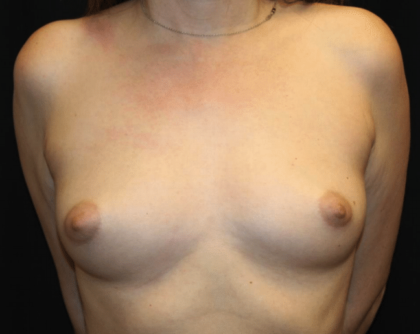 Breast Augmentation - Round Silicone Implants Before & After Patient #29059