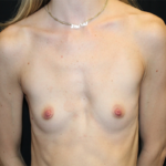 Breast Augmentation - Round Silicone Implants Before & After Patient #29099