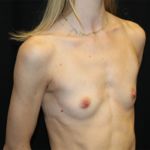 Breast Augmentation - Round Silicone Implants Before & After Patient #29099