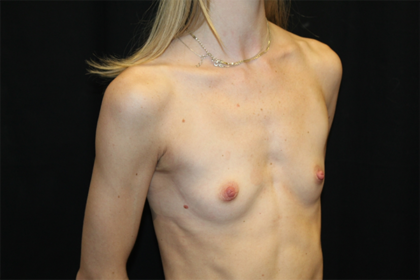 Breast Augmentation - Round Silicone Implants Before & After Patient #29099