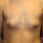 Breast Augmentation - Saline Implants Before & After Patient #29133