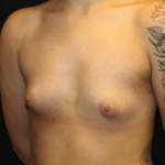 Breast Augmentation - Saline Implants Before & After Patient #29133