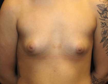 Breast Augmentation - Saline Implants Before & After Patient #29133