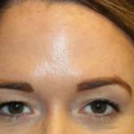 Botox and Dysport Before & After Patient #29249
