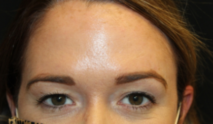 Botox and Dysport Before & After Patient #29249