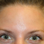 Botox and Dysport Before & After Patient #29226