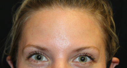 Botox and Dysport Before & After Patient #29226