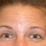 Botox and Dysport Before & After Patient #29226