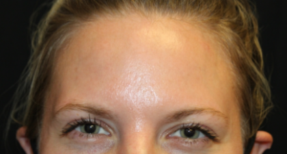 Botox and Dysport Before & After Patient #29226