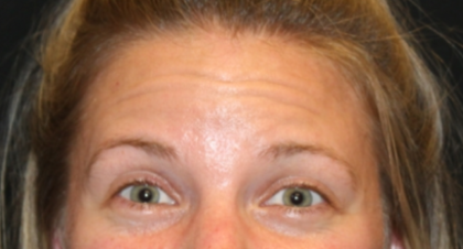 Botox and Dysport Before & After Patient #29226