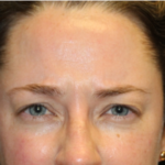 Botox and Dysport Before & After Patient #29232