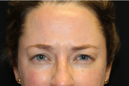 Botox and Dysport Before & After Patient #29232