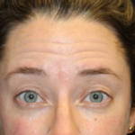 Botox and Dysport Before & After Patient #29232