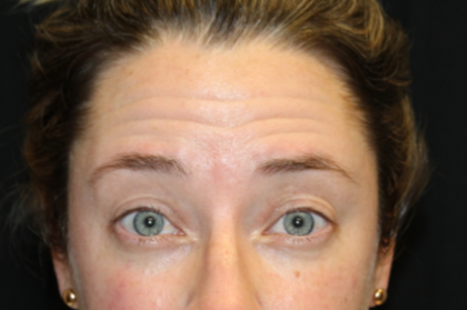 Botox and Dysport Before & After Patient #29232