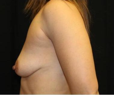 Breast Lift with Implant Before & After Patient #29195