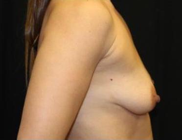 Breast Lift with Implant Before & After Patient #29195