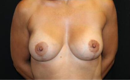 Breast Lift with Implant Before & After Patient #29195