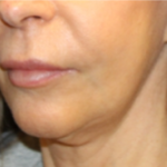 Botox and Dysport Before & After Patient #29256