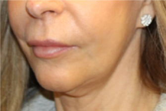 Botox and Dysport Before & After Patient #29256