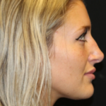 Botox and Dysport Before & After Patient #29237