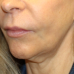 Botox and Dysport Before & After Patient #29256