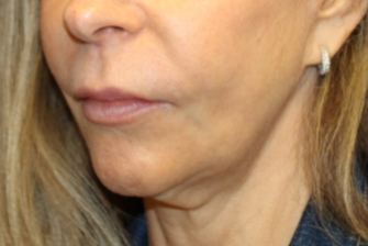 Botox and Dysport Before & After Patient #29256