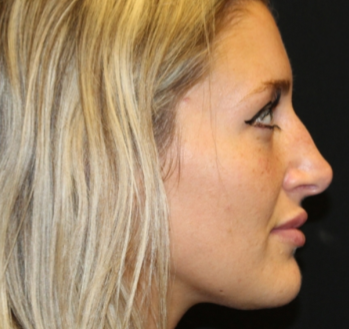 Botox and Dysport Before & After Patient #29237