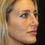 Botox and Dysport Before & After Patient #29237