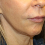 Botox and Dysport Before & After Patient #29256