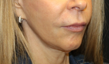 Botox and Dysport Before & After Patient #29256