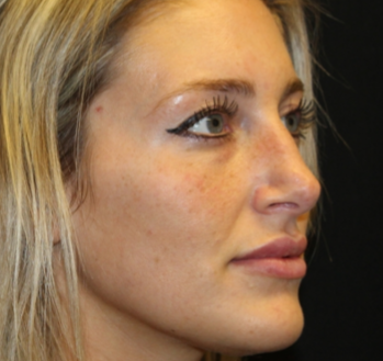 Botox and Dysport Before & After Patient #29237