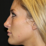Botox and Dysport Before & After Patient #29237