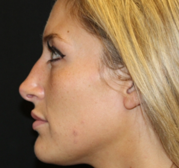 Botox and Dysport Before & After Patient #29237