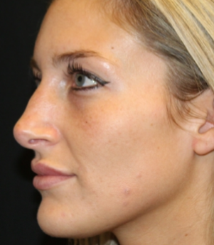 Botox and Dysport Before & After Patient #29237