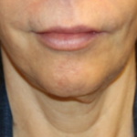Botox and Dysport Before & After Patient #29256