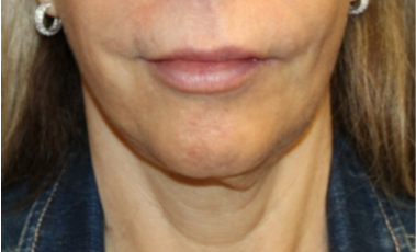 Botox and Dysport Before & After Patient #29256