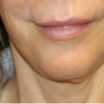 Botox and Dysport Before & After Patient #29256