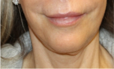 Botox and Dysport Before & After Patient #29256