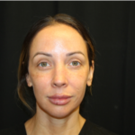 Injectable Fillers Before & After Patient #29188