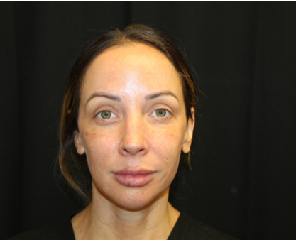 Injectable Fillers Before & After Patient #29188