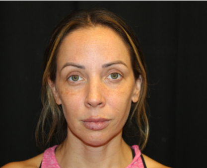 Injectable Fillers Before & After Patient #29188