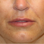 Lip Filler Before & After Patient #29221