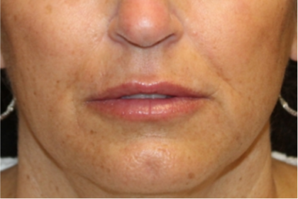 Lip Filler Before & After Patient #29221