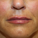 Lip Filler Before & After Patient #29221