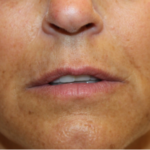 Lip Filler Before & After Patient #29221