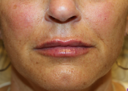 Lip Filler Before & After Patient #29221